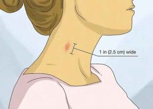 How to identify a hickey