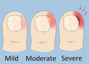 How to know whether ingrown nails will heal on their own